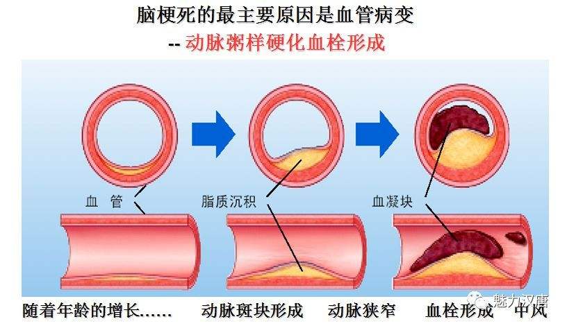 脑动脉粥样硬化形成的“四大帮凶”
