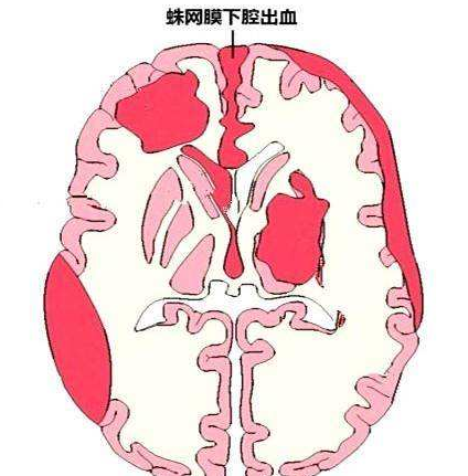 蛛网膜下腔出血