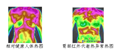 红外热成像扫描技术（GTT）在早期胃肠部疾病筛查中的重要应用 