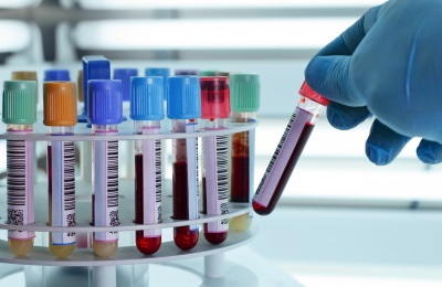 体检哪些项目需要抽血 抽血检查注意哪些