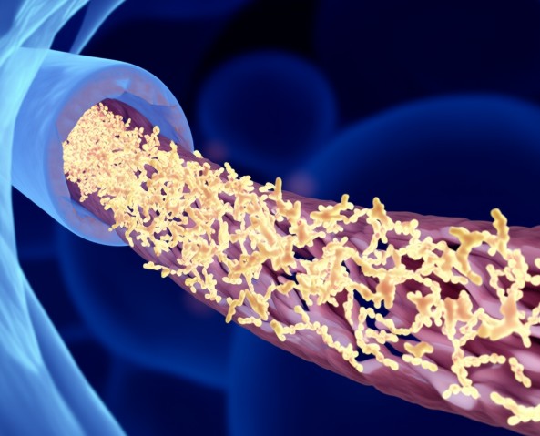 动脉硬化检查有辐射吗? 动脉硬化检查有辐射吗?