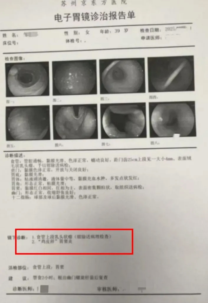 邹女士的胃镜检查报告 邹女士的胃镜检查报告