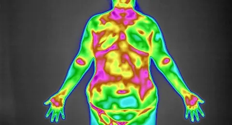 邹女士的热像图 邹女士的热像图