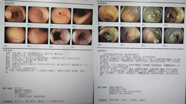 消化道病变在发生发展过程中