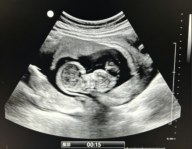 做B超需要准备什么