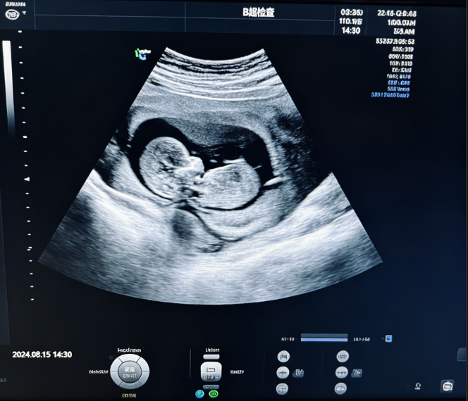 做B超检查的过程有什么注意事项？